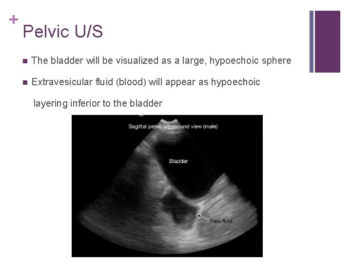 + Pelvic U/S n The bladder will be visualized as a large, hypoechoic sphere