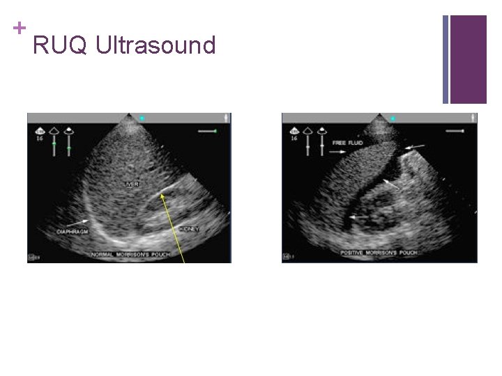 + RUQ Ultrasound 