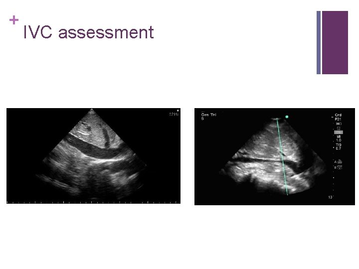 + IVC assessment 