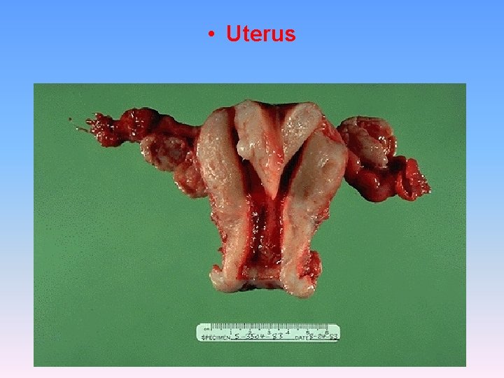  • Uterus 