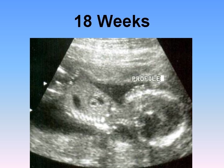 18 Weeks 