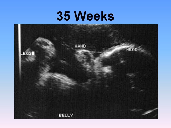 35 Weeks 