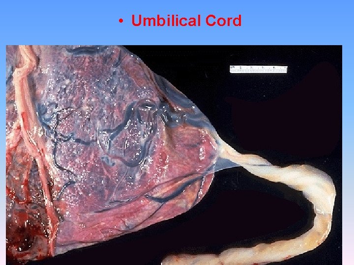  • Umbilical Cord 