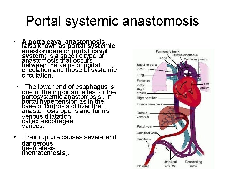 Portal systemic anastomosis • A porta caval anastomosis (also known as portal systemic anastomosis