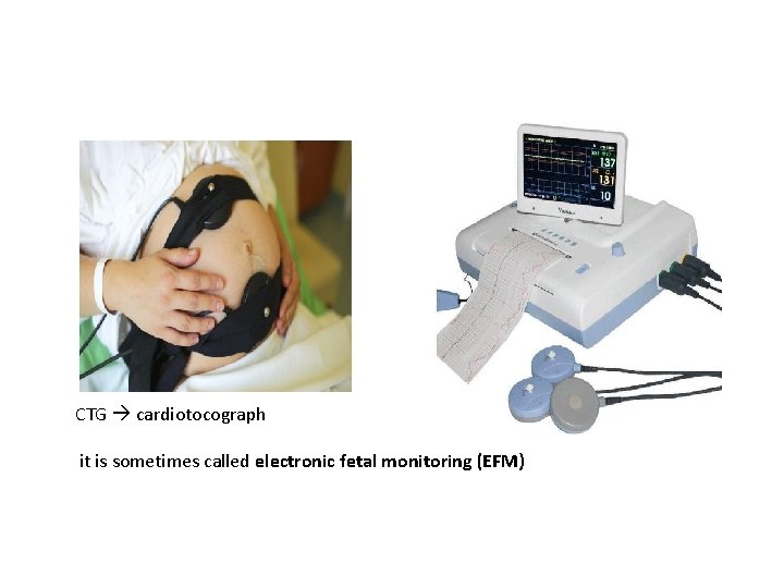 CTG cardiotocograph it is sometimes called electronic fetal monitoring (EFM) 
