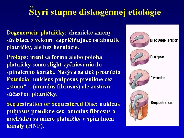 Štyri stupne diskogénnej etiológie Degenerácia platničky: chemické zmeny súvisiace s vekom, zapríčiňujúce oslabnutie platničky,