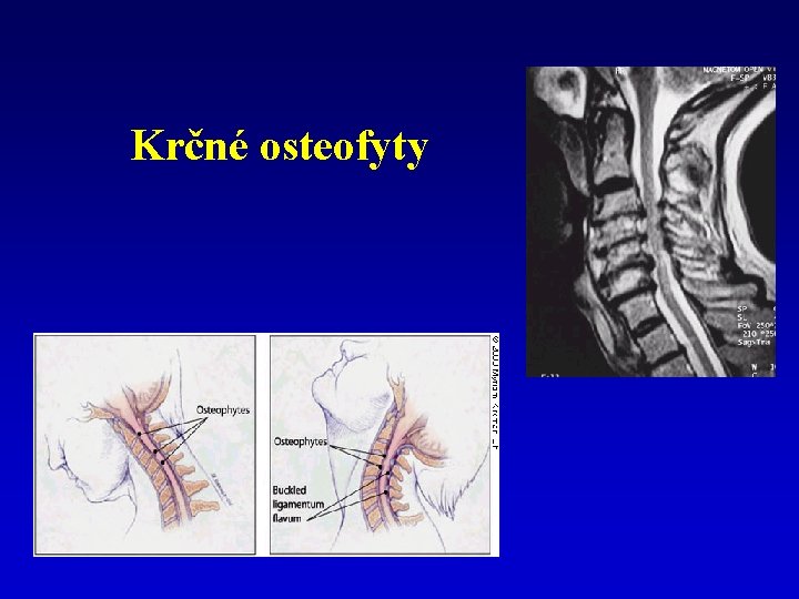 Krčné osteofyty 