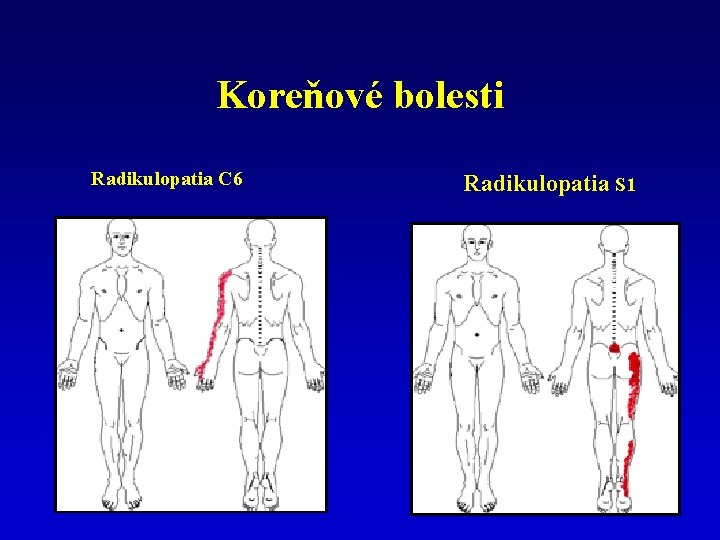 Koreňové bolesti Radikulopatia C 6 Radikulopatia S 1 