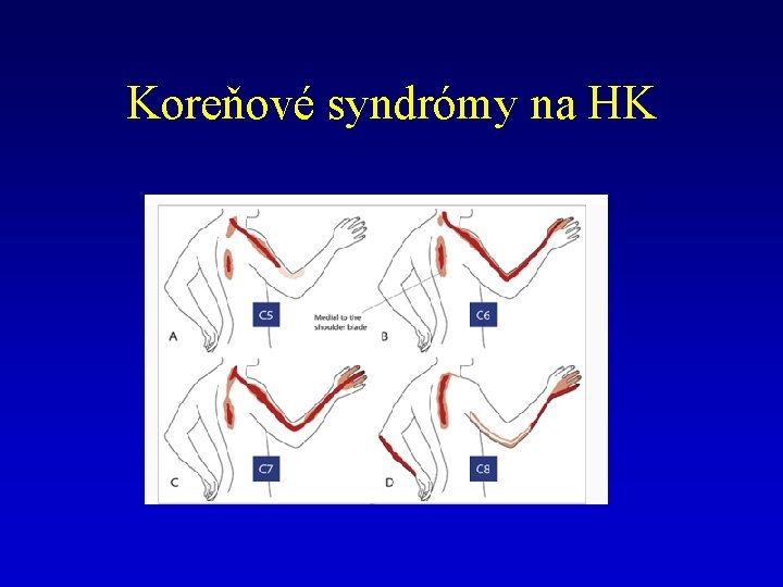 Koreňové syndrómy na HK 