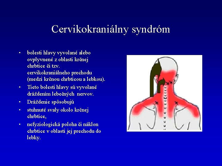 Cervikokraniálny syndróm • • • bolesti hlavy vyvolané alebo ovplyvnené z oblasti krčnej chrbtice