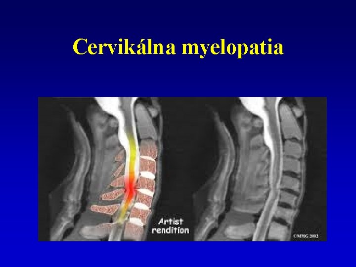 Cervikálna myelopatia 