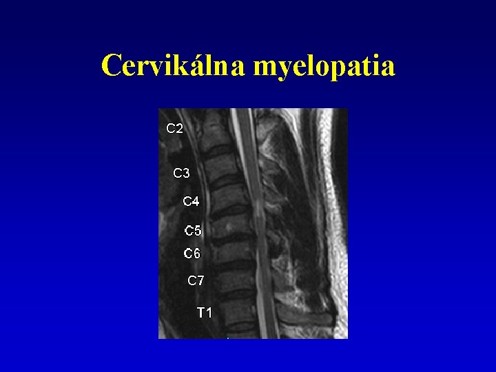 Cervikálna myelopatia 