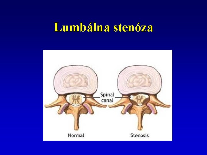 Lumbálna stenóza 