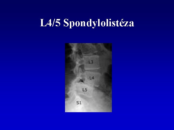 L 4/5 Spondylolistéza 