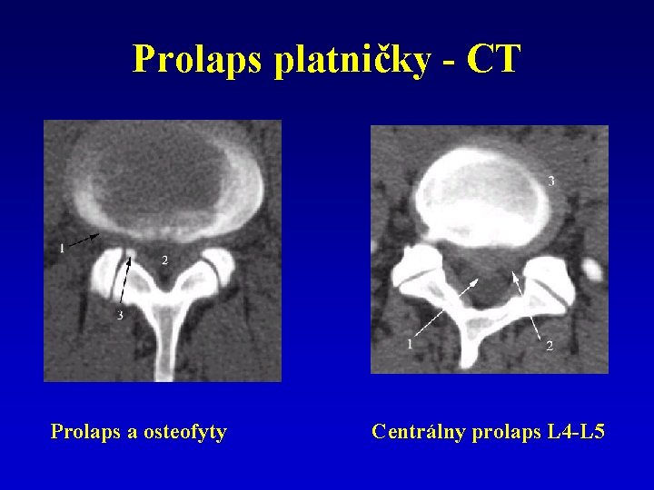 Prolaps platničky - CT Prolaps a osteofyty Centrálny prolaps L 4 -L 5 