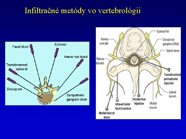 Infiltračné metódy vo vertebrológii 