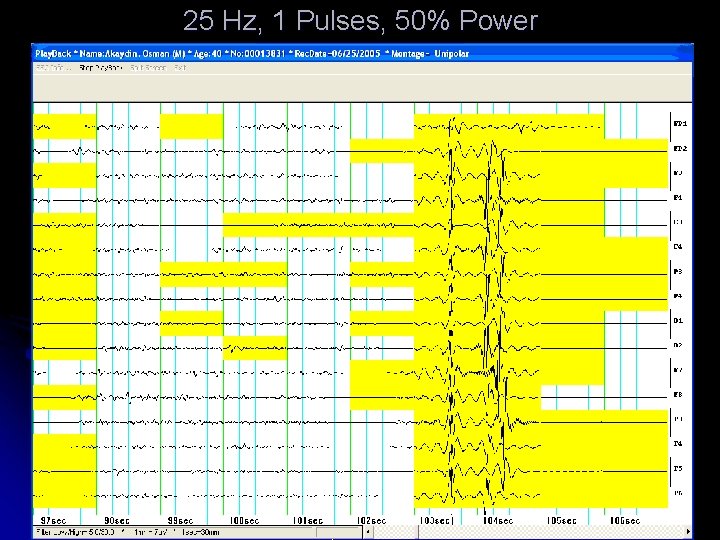 25 Hz, 1 Pulses, 50% Power 