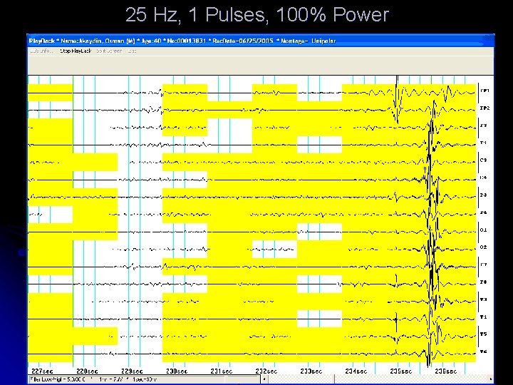 25 Hz, 1 Pulses, 100% Power 