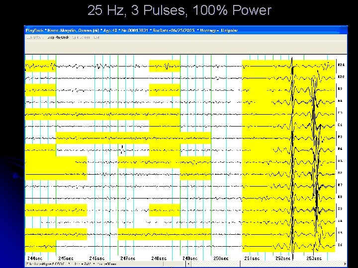 25 Hz, 3 Pulses, 100% Power 