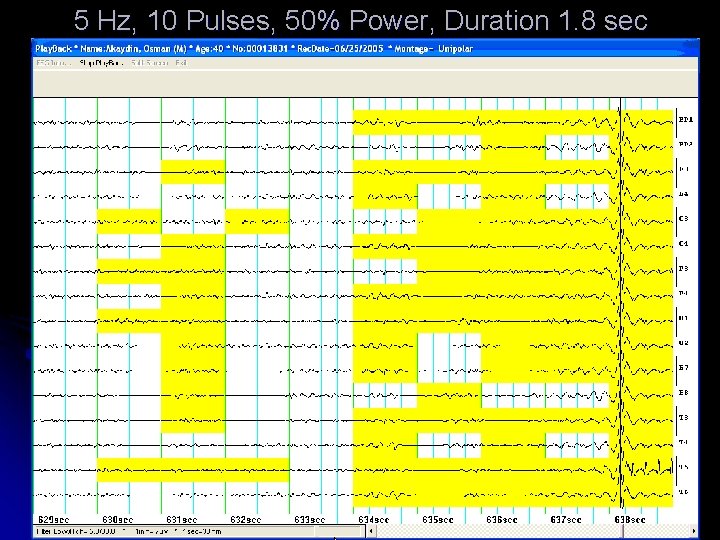 5 Hz, 10 Pulses, 50% Power, Duration 1. 8 sec 