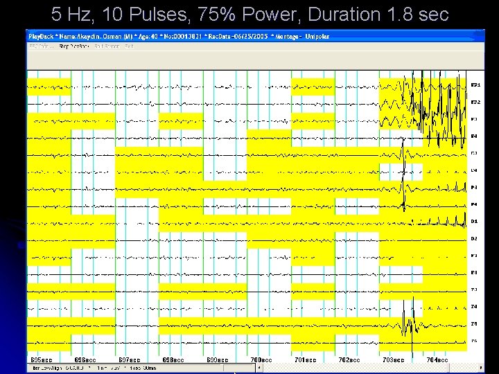 5 Hz, 10 Pulses, 75% Power, Duration 1. 8 sec 