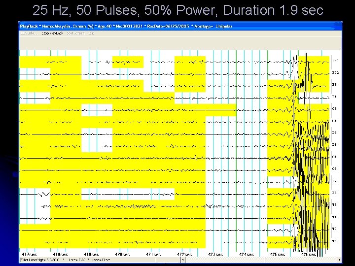 25 Hz, 50 Pulses, 50% Power, Duration 1. 9 sec 