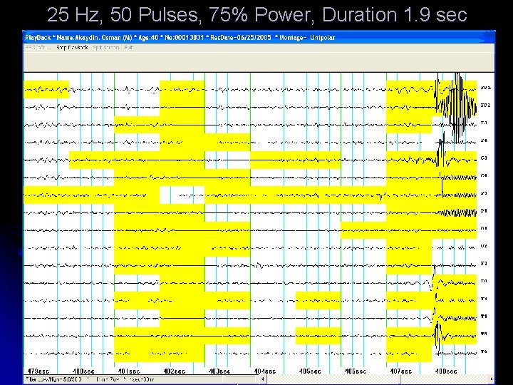 25 Hz, 50 Pulses, 75% Power, Duration 1. 9 sec 