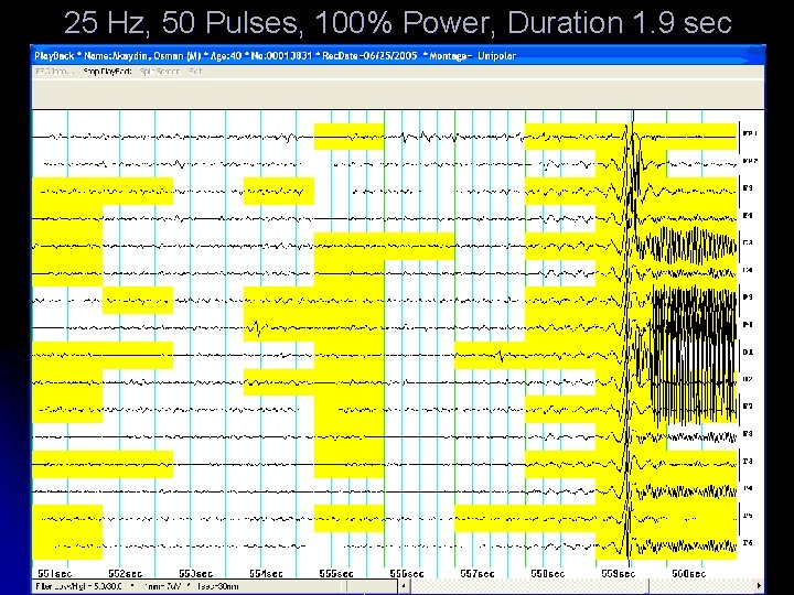 25 Hz, 50 Pulses, 100% Power, Duration 1. 9 sec 