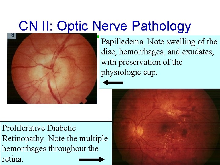 CN II: Optic Nerve Pathology Papilledema. Note swelling of the disc, hemorrhages, and exudates,