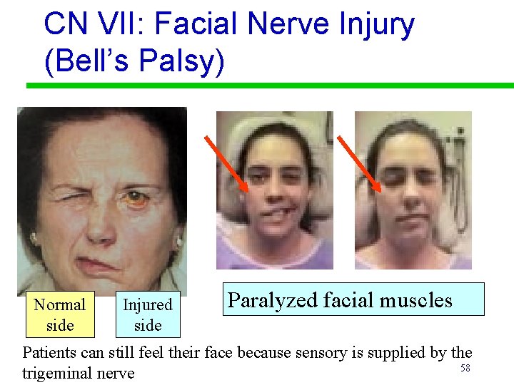 CN VII: Facial Nerve Injury (Bell’s Palsy) Normal side Injured side Paralyzed facial muscles