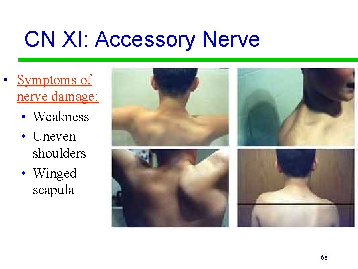 CN XI: Accessory Nerve • Symptoms of nerve damage: • Weakness • Uneven shoulders