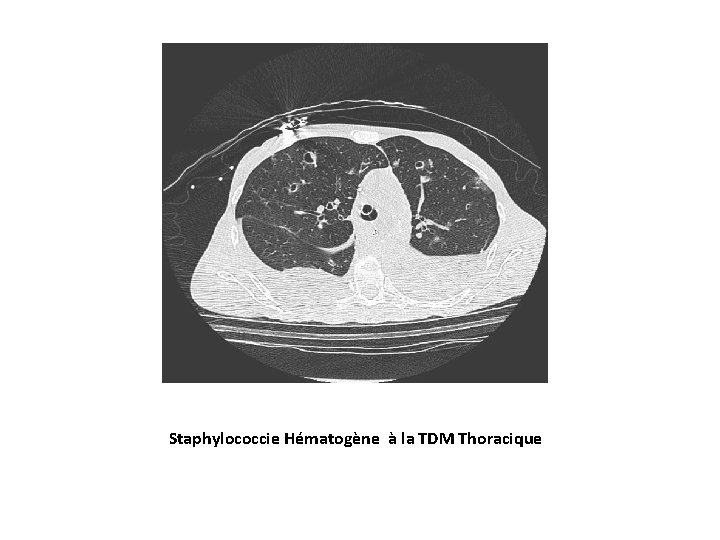Staphylococcie Hématogène à la TDM Thoracique 