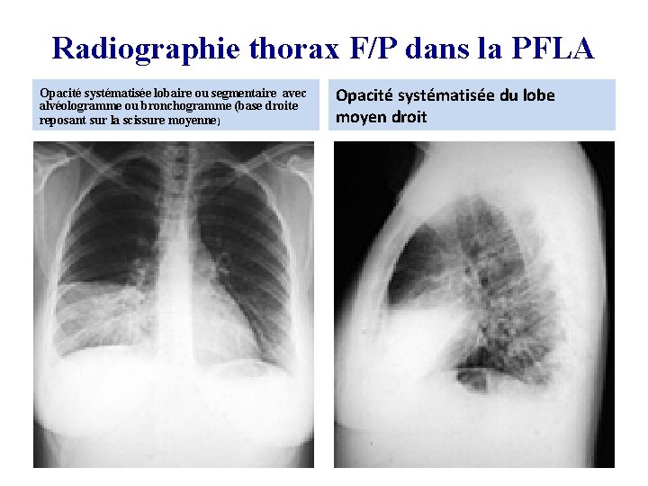 Radiographie thorax F/P dans la PFLA Opacité systématisée lobaire ou segmentaire avec alvéologramme ou