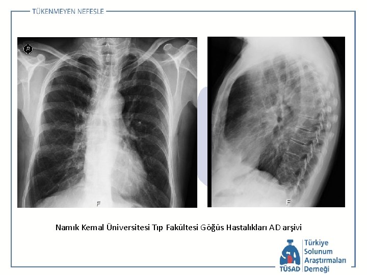 Namık Kemal Üniversitesi Tıp Fakültesi Göğüs Hastalıkları AD arşivi 