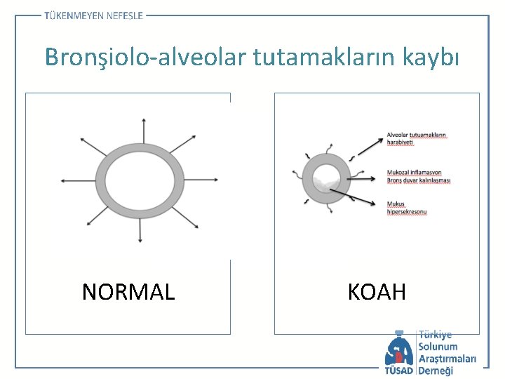 Bronşiolo-alveolar tutamakların kaybı NORMAL KOAH 
