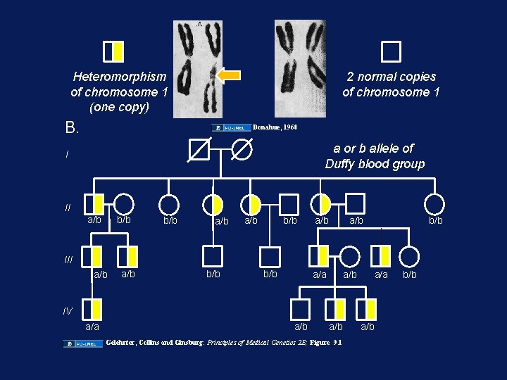 Heteromorphism of chromosome 1 (one copy) 2 normal copies of chromosome 1 B. Donahue,