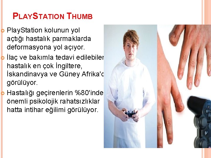 PLAYSTATION THUMB Play. Station kolunun yol açtığı hastalık parmaklarda deformasyona yol açıyor. İlaç ve