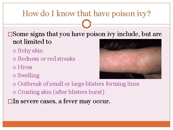 How do I know that have poison ivy? �Some signs that you have poison