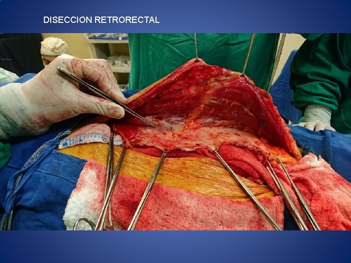 DISECCION RETRORECTAL 