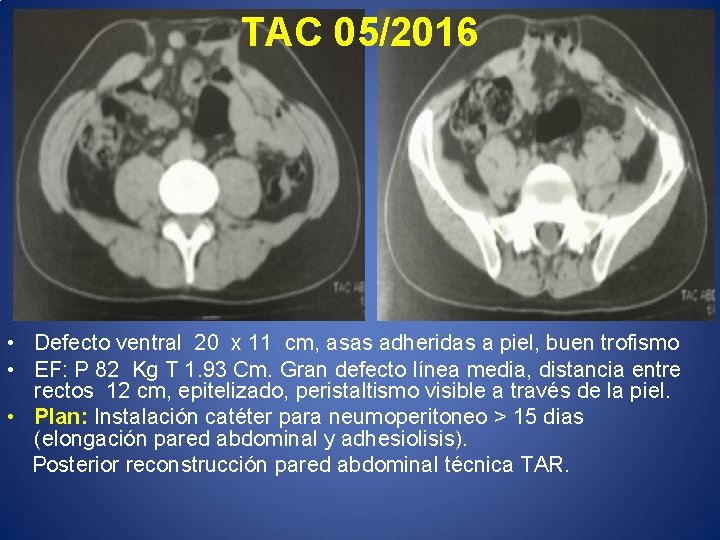 TAC 05/2016 • Defecto ventral 20 x 11 cm, asas adheridas a piel, buen