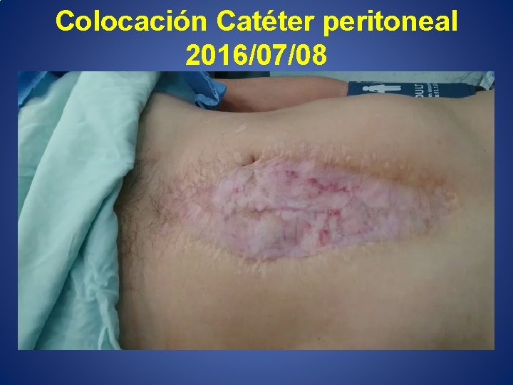 Colocación Catéter peritoneal 2016/07/08 