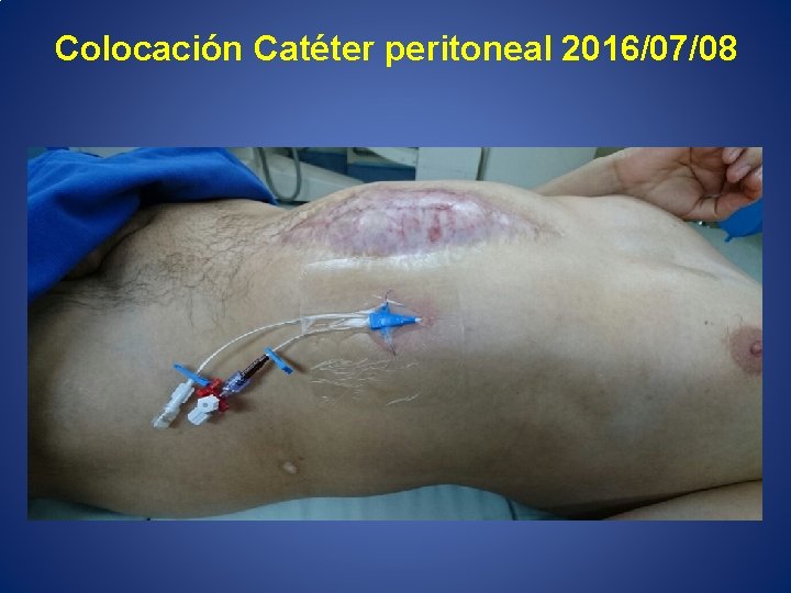 Colocación Catéter peritoneal 2016/07/08 