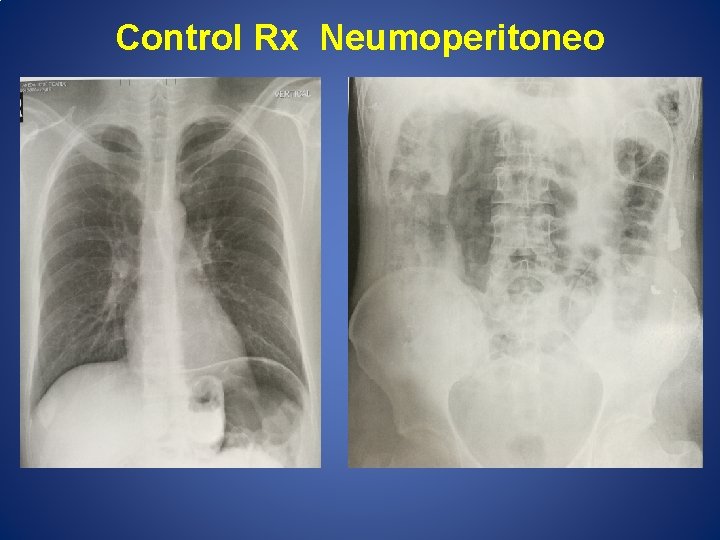Control Rx Neumoperitoneo 