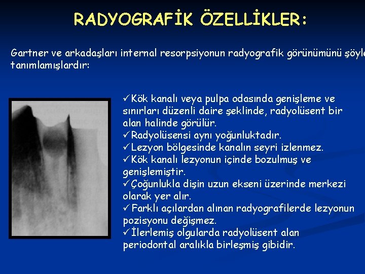 RADYOGRAFİK ÖZELLİKLER: Gartner ve arkadaşları internal resorpsiyonun radyografik görünümünü şöyle tanımlamışlardır: üKök kanalı veya