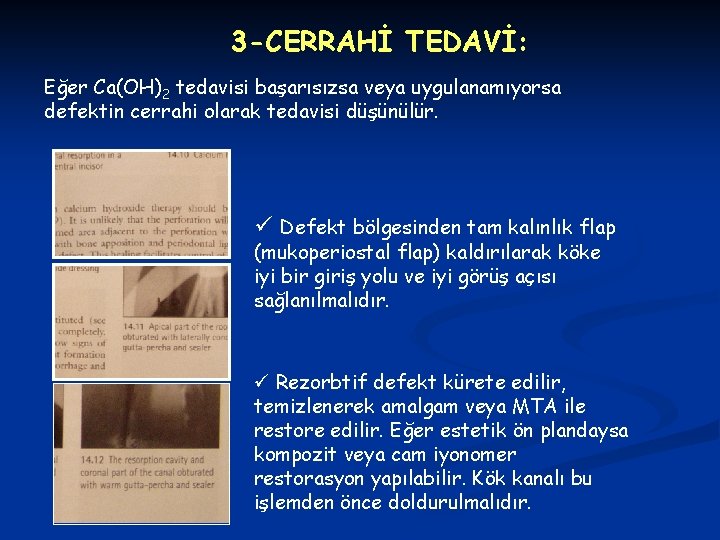 3 -CERRAHİ TEDAVİ: Eğer Ca(OH)2 tedavisi başarısızsa veya uygulanamıyorsa defektin cerrahi olarak tedavisi düşünülür.