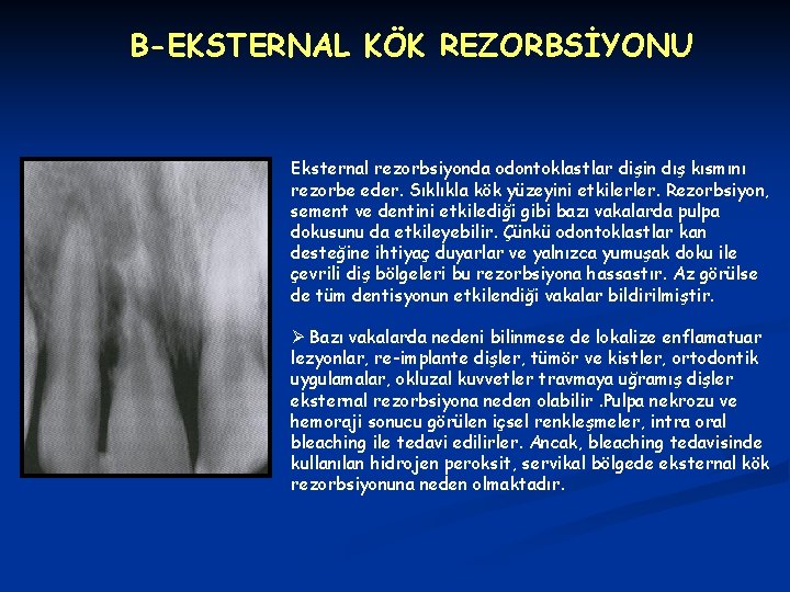 B-EKSTERNAL KÖK REZORBSİYONU Eksternal rezorbsiyonda odontoklastlar dişin dış kısmını rezorbe eder. Sıklıkla kök yüzeyini