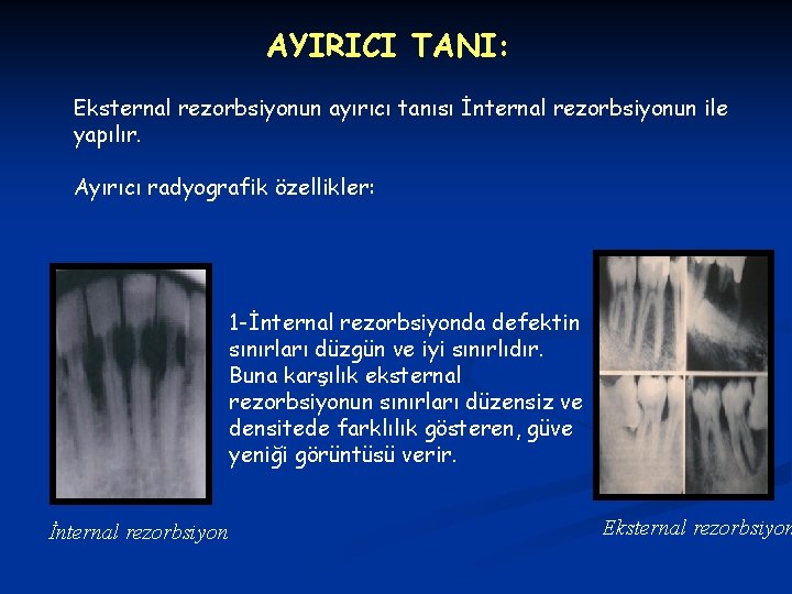 AYIRICI TANI: Eksternal rezorbsiyonun ayırıcı tanısı İnternal rezorbsiyonun ile yapılır. Ayırıcı radyografik özellikler: 1