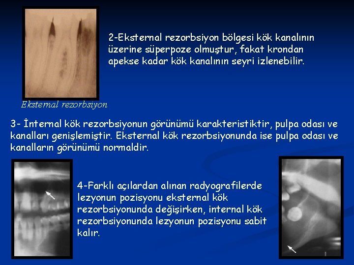 2 -Eksternal rezorbsiyon bölgesi kök kanalının üzerine süperpoze olmuştur, fakat krondan apekse kadar kök