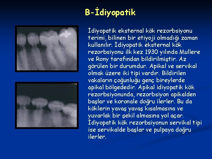 B-İdiyopatik eksternal kök rezorbsiyonu terimi, bilinen bir etiyoji olmadığı zaman kullanılır. İdiyopatik eksternal kök