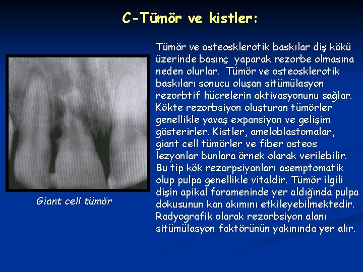 C-Tümör ve kistler: Giant cell tümör Tümör ve osteosklerotik baskılar diş kökü üzerinde basınç